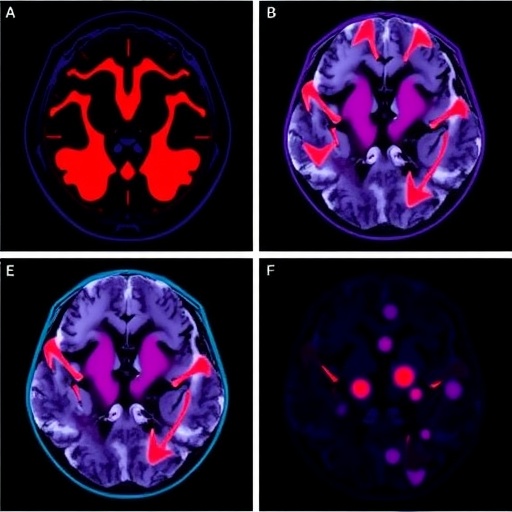 polyclonal-tumor-reactive-lymphocytes-for-personalized-glioblastoma-therapy