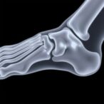 assessing-metatarsus-adductus-angle:-reliability-study