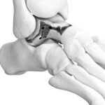 3d-printed-orthopedic-implant-maker-restor3d-raises-$104m