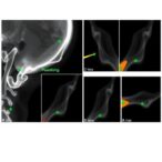 deep-learning-classifies-mandibular-condyle-variations-in-radiographs