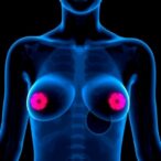 low-risk-of-developing-second-cancer-following-early-breast-cancer-diagnosis