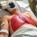 clarifying-ecmo-weaning-with-neurally-adjusted-ventilation
