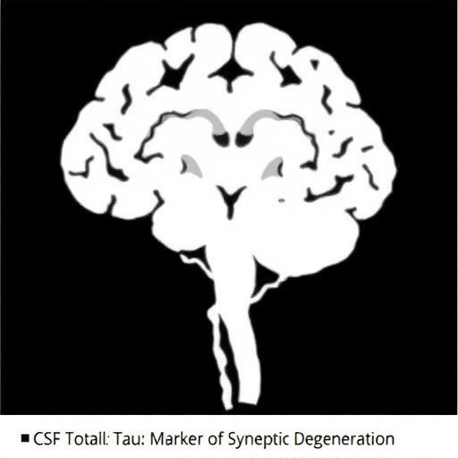 csf-total-tau:-marker-of-synaptic-degeneration