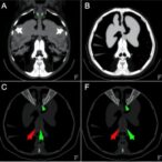 predicting-hodgkin’s-lymphoma-response-with-pet/ct
