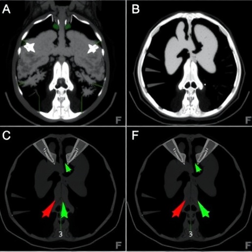 predicting-hodgkin’s-lymphoma-response-with-pet/ct