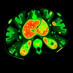 predicting-hodgkin’s-lymphoma-response-with-18fdg-pet/ct