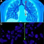 cbfa2t3:-a-key-lung-adenocarcinoma-prognostic-biomarker