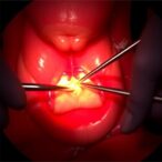 mini-percutaneous-nephrolithotomy:-iau-best-practice-insights