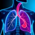 link-between-lung-disease-and-esophageal-cancer-revealed