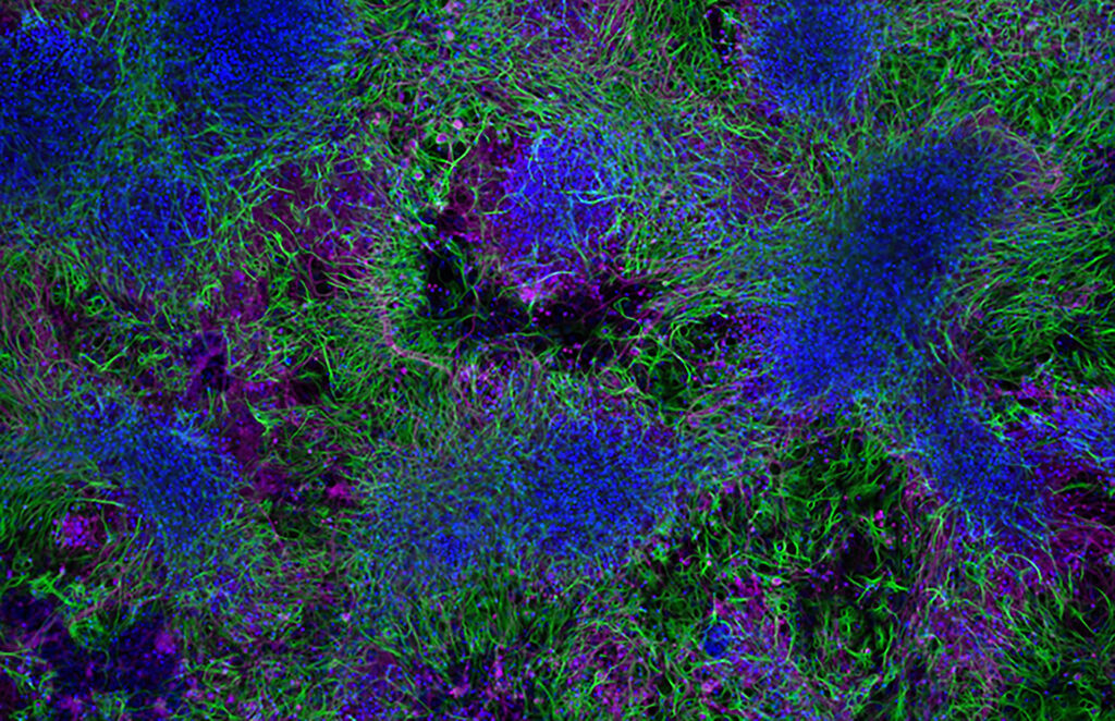 how-spatial-biology-is-unlocking-a-new-dimension-in-cancer-research