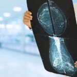 spanish-oncology-research-group-medsir-infuses-ai-into-breast-cancer-trials