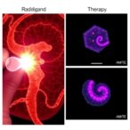 radioligand-therapy’s-impact-on-neuroendocrine-tumors