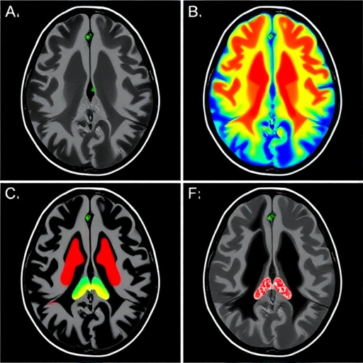 mri-reveals-regional-drivers-of-human-csf-flow