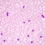 leukemia-progression-mapped-by-new-multi-omics-tool,-got-multi