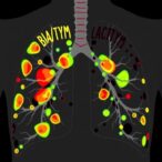 mapping-lymph-node-metastasis-in-lung-adenocarcinoma