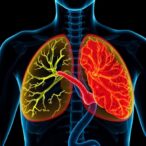 exome-sequencing-uncovers-inflammatory-breast-cancer-insights