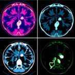 comparing-cyberknife-techniques-for-diverse-tumor-types
