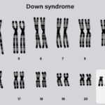 missing-molecule-may-explain-down-syndrome