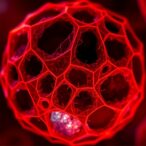 craters-on-melanoma-cell-surfaces-identified-as-key-sites-for-tumor-destruction