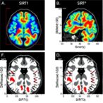 sirt1-and-sirt3-levels-after-fatal-brain-injury