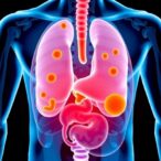 curcumin’s-role-in-prostate-cancer-therapy