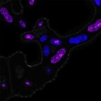 arnt2-activates-stra6,-fueling-liposarcoma-progression