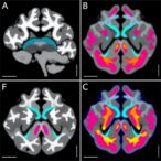 radiopathomics-models-predict-diffuse-glioma-subtypes-and-grades