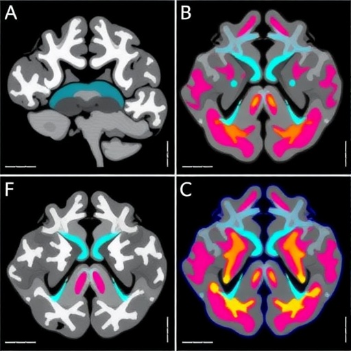 radiopathomics-models-predict-diffuse-glioma-subtypes-and-grades