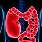 shed-dna-from-colon-cancers-could-tailor-postsurgical-treatments
