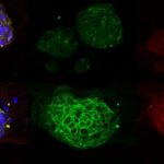 ai-treatment-reprograms-and-triggers-cancer-stem-cells-to-self-destruct
