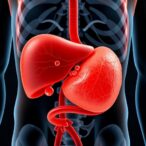 gallstones-in-accessory-gallbladder-of-extra-liver