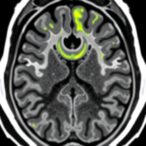 ai-predicts-liver-cancer-invasion-via-mri