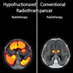 hypofractionated-vs.-conventional-radiotherapy:-prostate-cancer-comparison