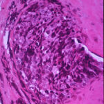 kinase-inhibitor-shows-promise-in-children-with-ewing-sarcoma