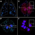 fhl2-boosts-lung-cancer-radioresistance-via-ecm-remodeling