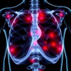 blocking-sting-il6/stat3-axis-halts-breast-cancer-bone-metastasis