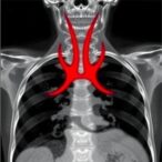 deadly-tracheal-rupture-diagnosed-by-post-mortem-imaging