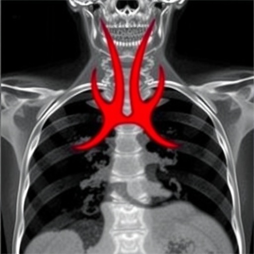 deadly-tracheal-rupture-diagnosed-by-post-mortem-imaging