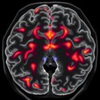 understanding-diffuse-leptomeningeal-glioneuronal-tumors
