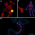 multisystem-inflammatory-syndrome:-sars-cov-2-triggered-kawasaki-disease