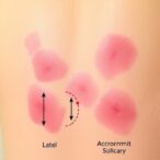 severe-acrodermatitis-enteropathica:-rare-late-onset-case
