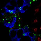 bmp-9-boosts-osteosarcoma-pd-l1-via-foxo1