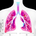 immunotherapy-plus-radiotherapy-in-advanced-lung-cancer