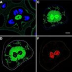 cd73-and-vegf-in-vietnamese-salivary-cancers