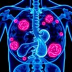 belzutifan-for-vhl-tumors:-single-center-study