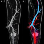 assessing-femoropopliteal-arteries:-health-vs.-revascularization