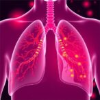 immune-checkpoint-inhibition-shifts-failure-patterns-in-lung-cancer