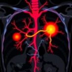 super-microvascular-imaging-enhances-axillary-node-diagnosis