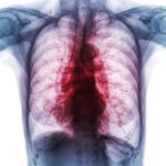 olympus-updates-corrective-action-related-to-2023-lung-scope-recall