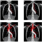 ai-powered-image-alignment-in-carotid-angiography-study